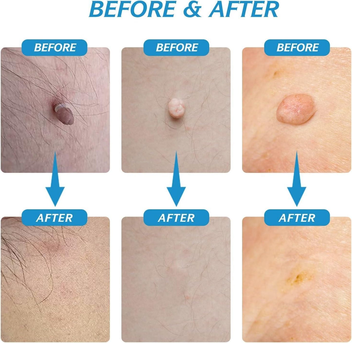 2 in 1 Skin Tag Remover Kit - Painless Beauty & Personal Care