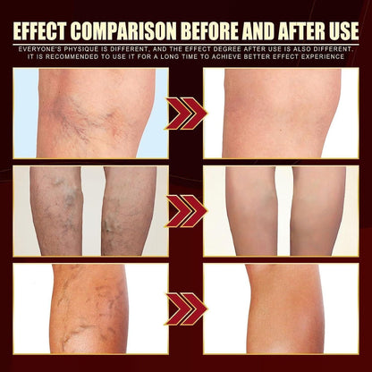 Vein Healing Varicose Veins Treatment Spray Pack of 2 Gym & Wellness