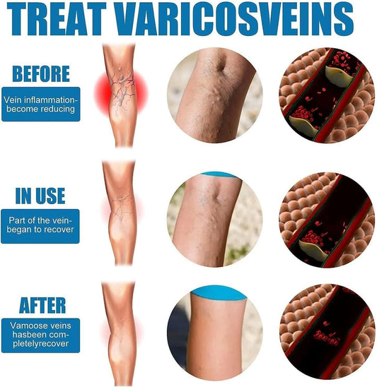 Vein Healing Varicose Veins Treatment Spray Pack of 2 Gym & Wellness
